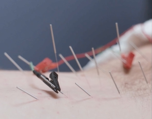 Unlocking the Power of Class IV Laser Therapy and Functional Dry Needling
